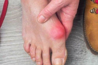 Are your shoes ruining your feet? Top surgeon reveals the best fixes for bunion